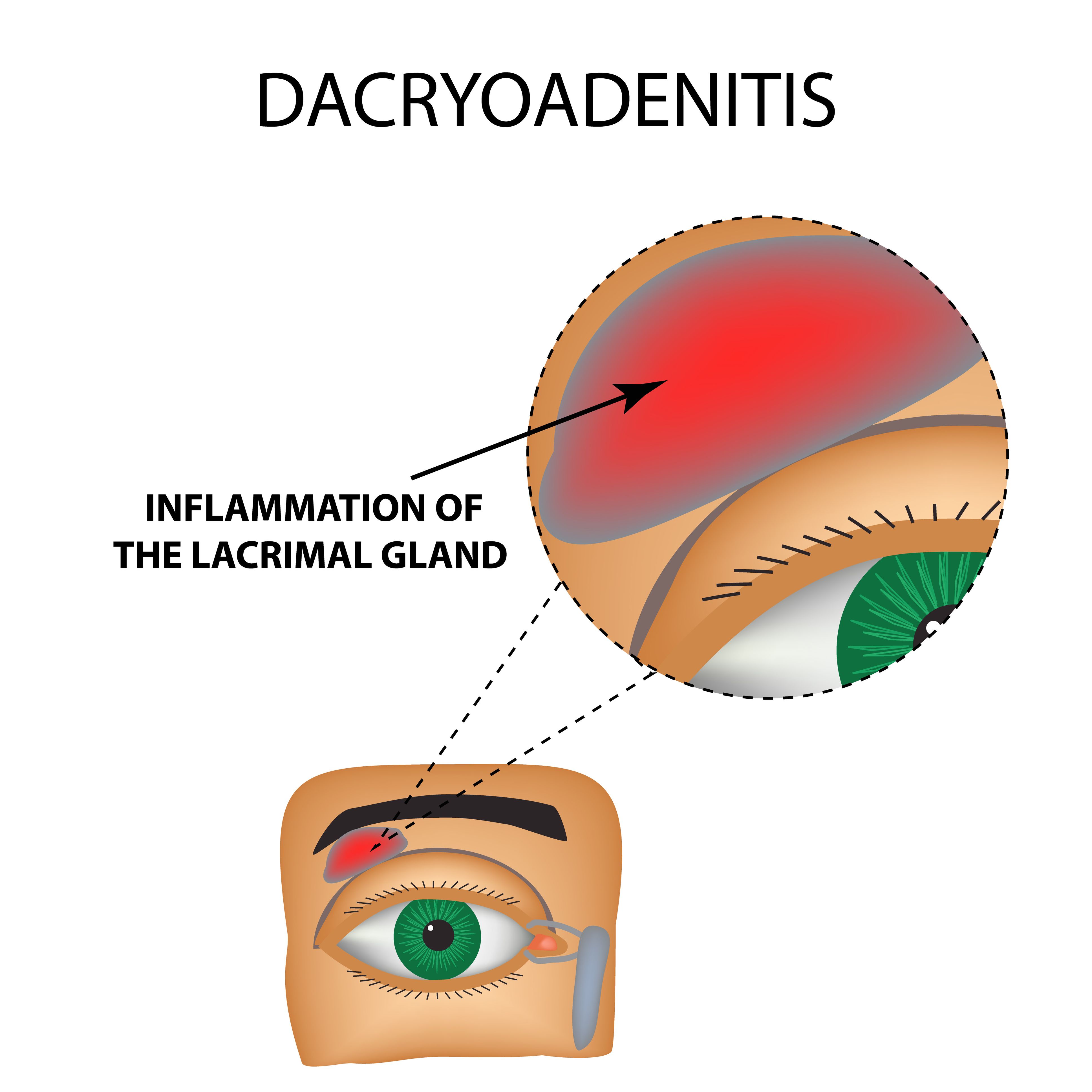 lacrimal sac inflammation