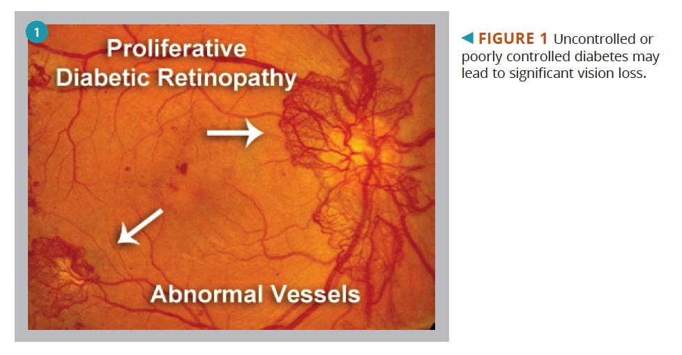 kezelése retinopathia diabetes)