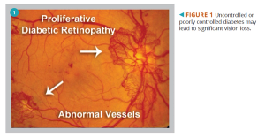 Proliferative diabetic retinopathy 