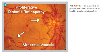 Proliferative diabetic retinopathy 