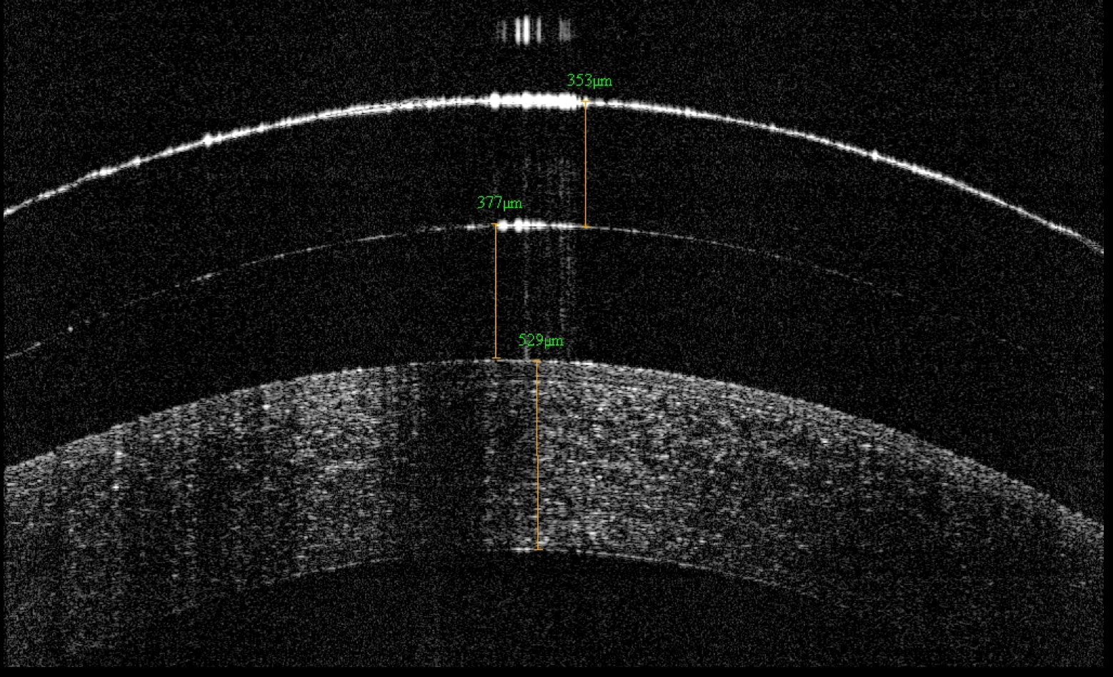Figure 1. OCT of central corneal clearance