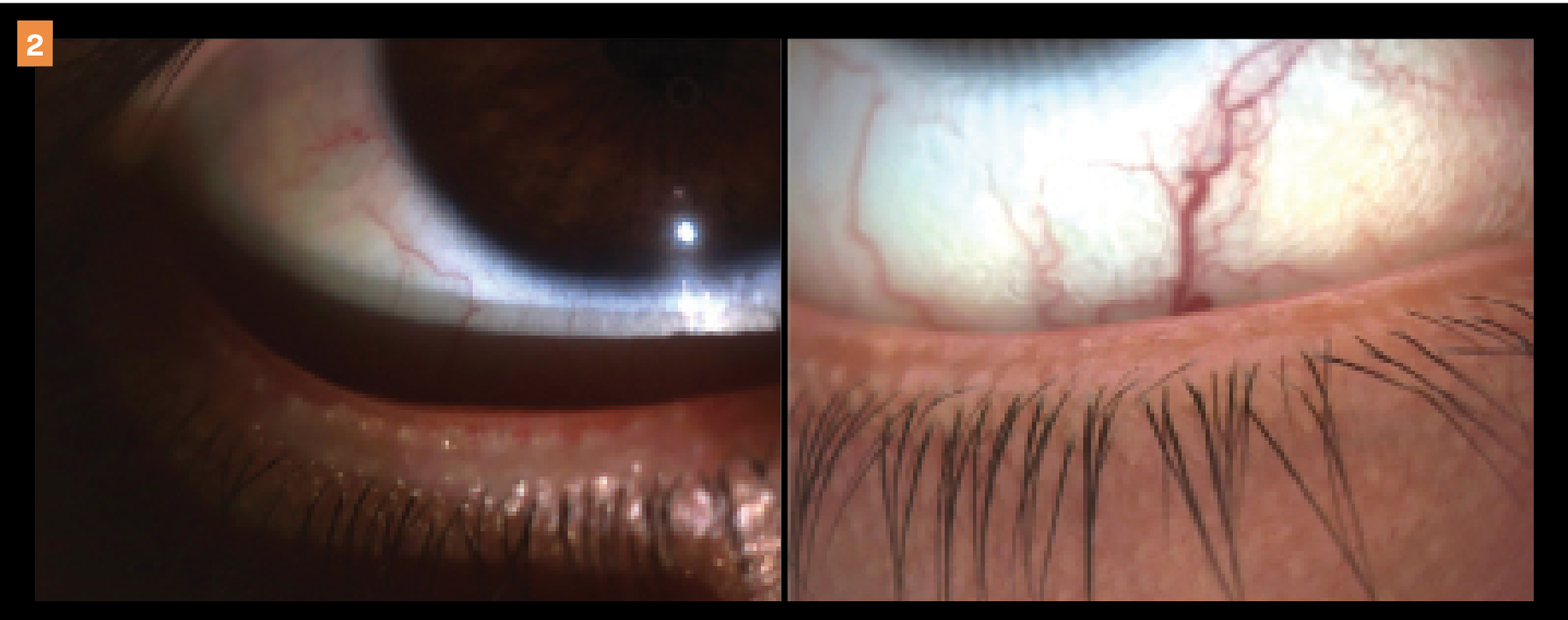 Patient with a recent history of taking oral isotretinoin, which led to dry eye disease and meibomian gland dysfunction. Images show before (left) and after (right) in-office treatments, where the lid margin integrity and meibum function can be seen improving after office-based treatments.