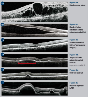 6 OCT pitfalls to avoid