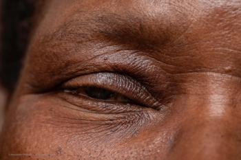 A 35-year-old woman presents with ptosis of the right eyelid 4 days after undergoing injection of botulinum toxin type A.