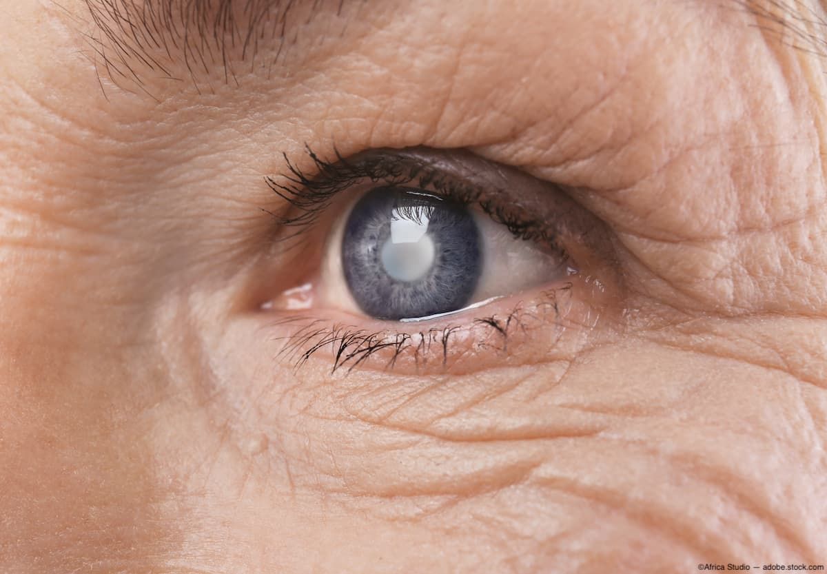 Older person with cataracts Image credit: AdobeStock/AfricaStudio