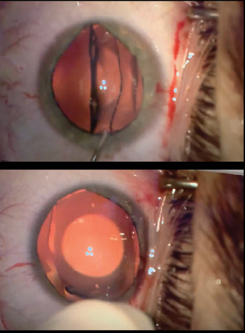 Phakic IOL implantation: Visual and refractive outcomes