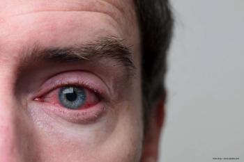 conjunctivitis seems to be main symptom of new strain of bird flu - ©ink drop
