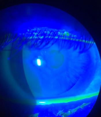dry eye up close photo