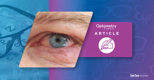 Closeup of irritated eye | Image credit: AdobeStock/MilosCirkovic