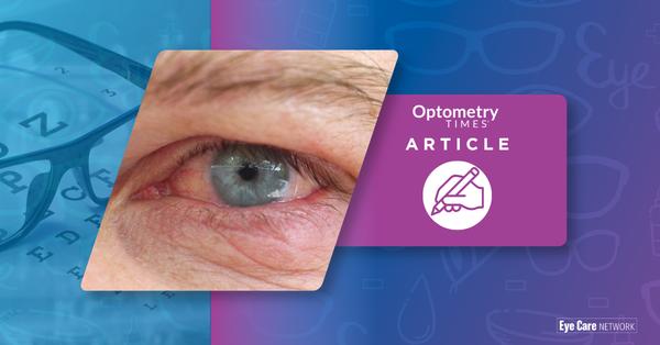 Closeup of irritated eye | Image credit: AdobeStock/MilosCirkovic