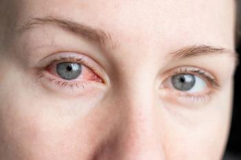 Woman with eye redness in one eye Image credit: AdobeStock/TatjanaMeininger