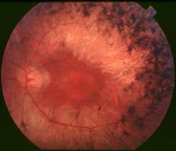 Genetic testing: Simplifying the diagnoses of inherited retinal diseases 