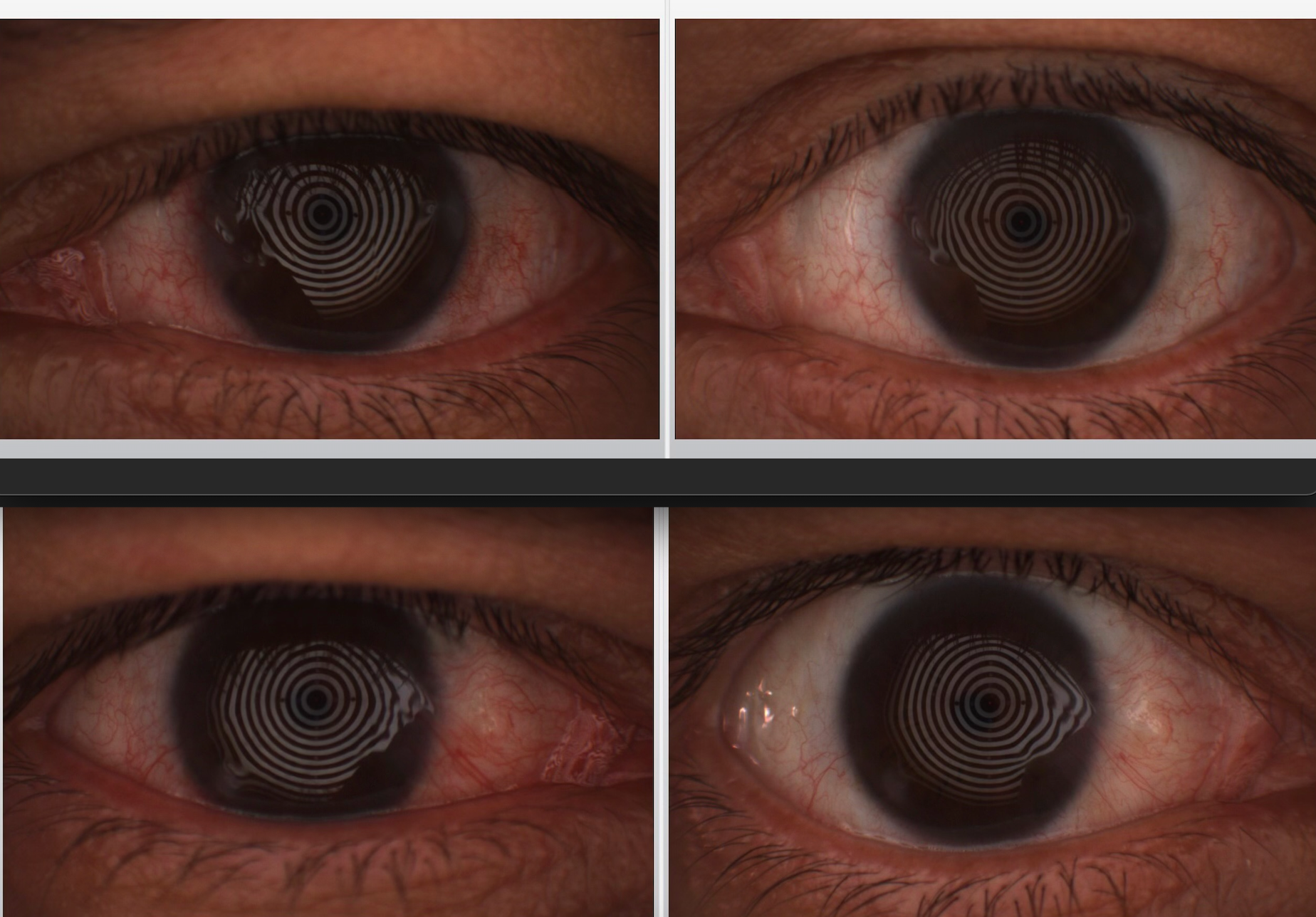 A patient experienced significant reduction in conjunctival redness after 4 treatments with OptiLight IPL. 
