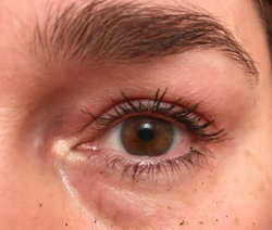Eyelid taping may offer temporary alternative to blepharoplasty