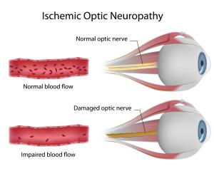 Optimizing ocular blood flow in glaucoma management