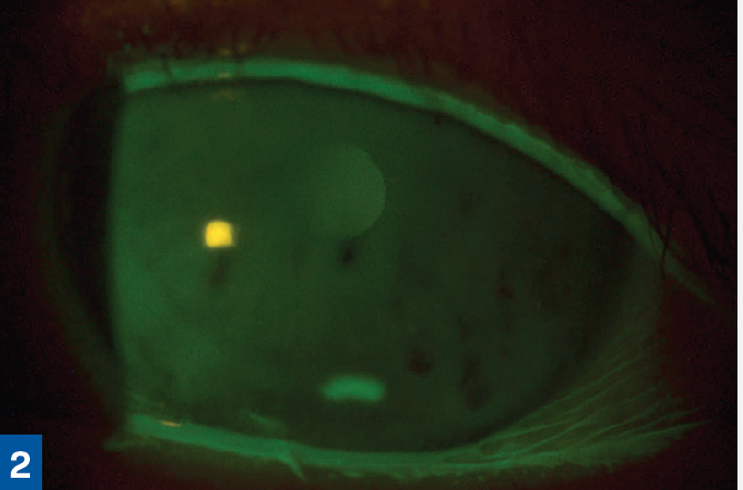 Figure 2. The eye 6 days after application of Prokera Slim. (All figures courtesy of Greg Caldwell, OD, FAAO)