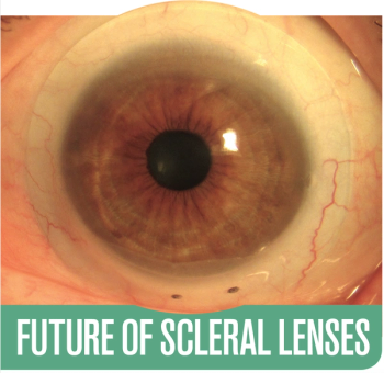 Contact lens on eyeball