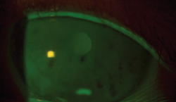 Case study: persistent keratitis OS presents in 68-year-old woman