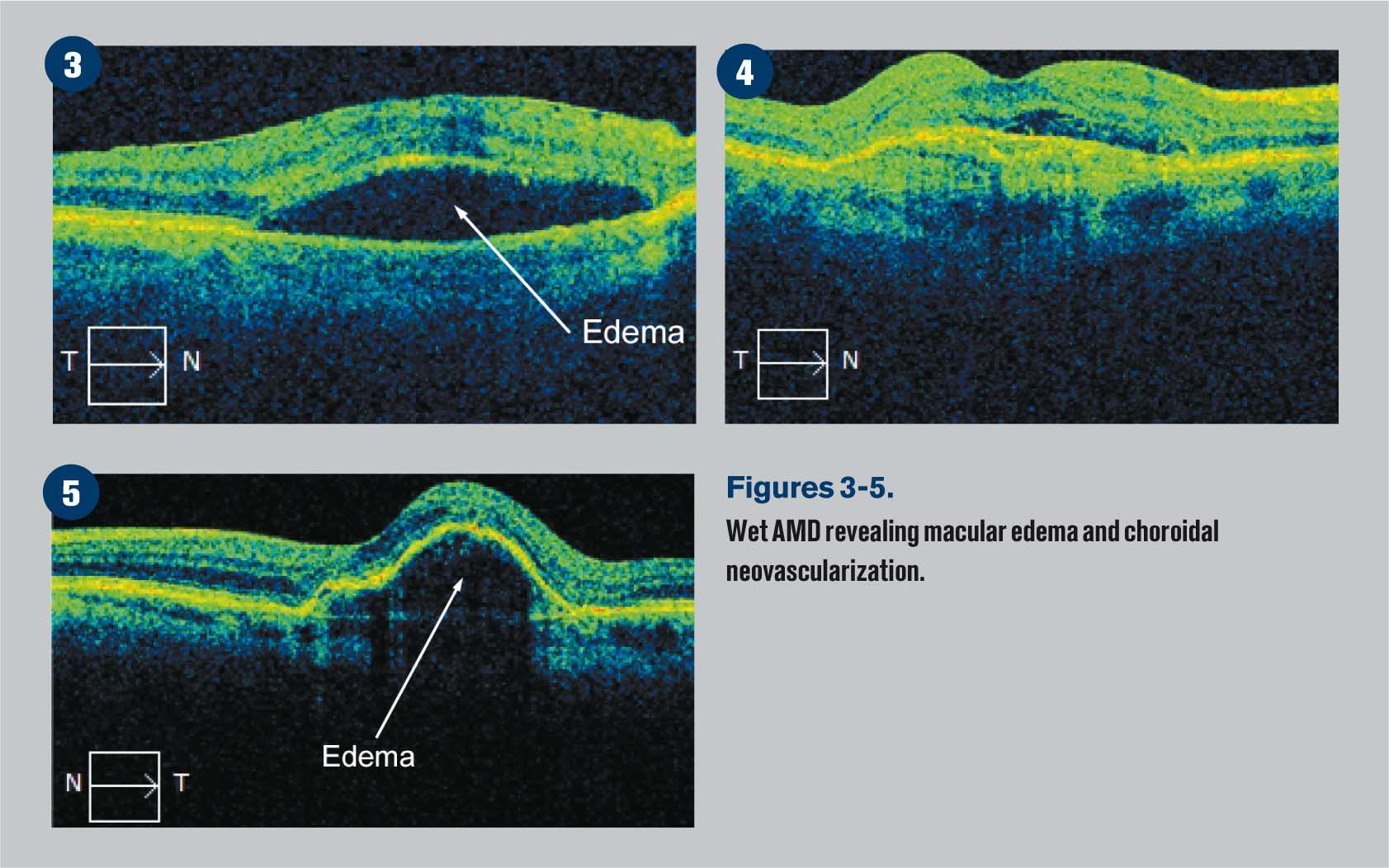 Identifying common macular conditions with OCT