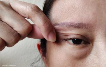 Viewing ptosis through a biopsychosocial lens