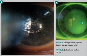10 tips to enhance scleral contact lens success