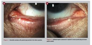 5 things you don’t know about punctal plugs