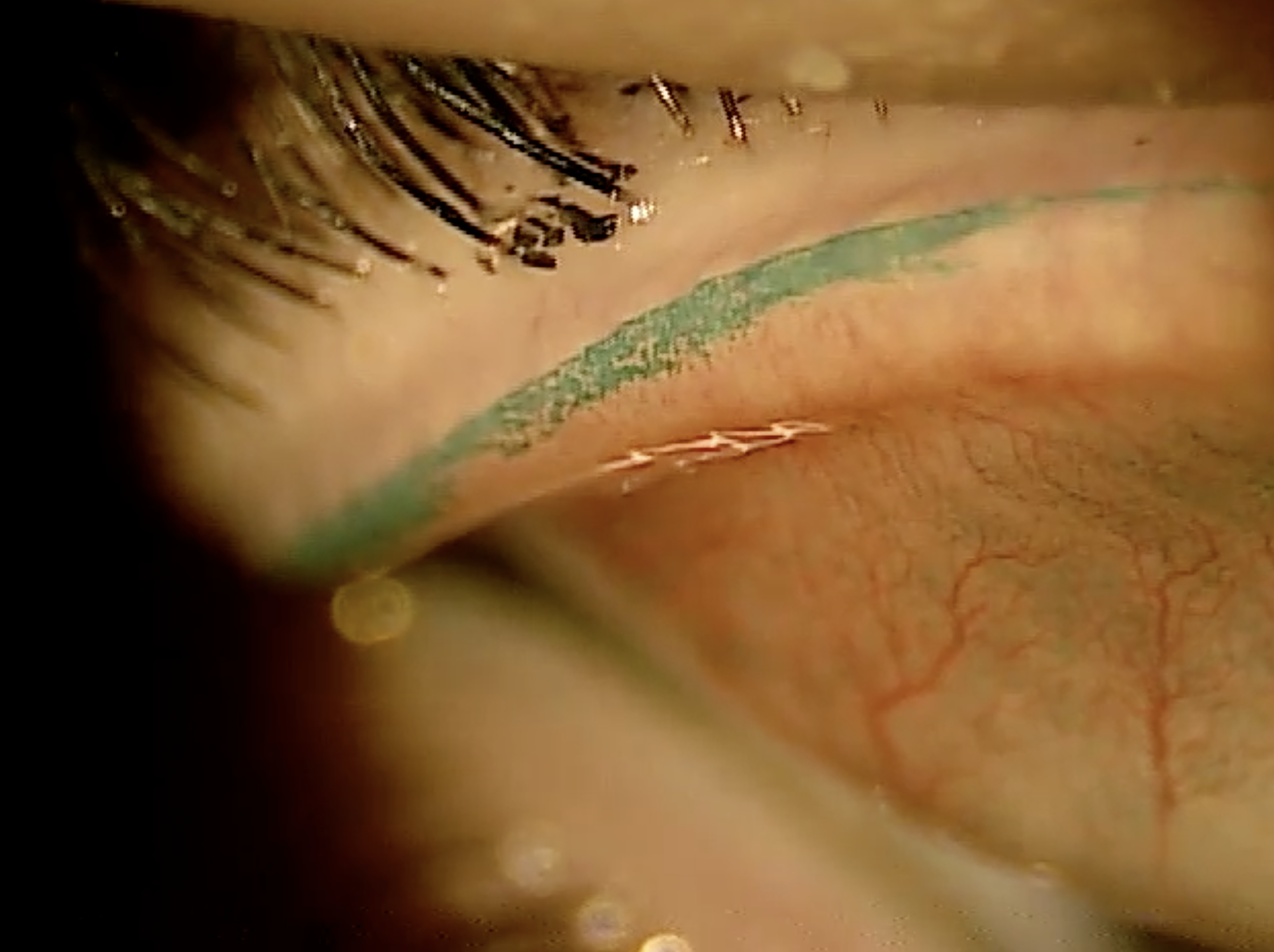 Why lid wiper epitheliopathy is a game changer