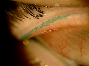 Why lid wiper epitheliopathy is a game changer