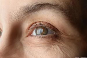 Closeup of eye with cataracts Image credit: ©New Africa - adobe.stock.com