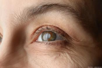 Closeup of eye with cataracts Image credit: ©New Africa - adobe.stock.com