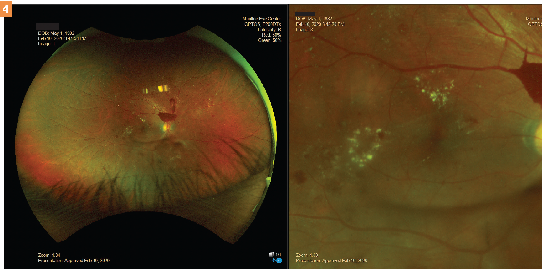 Figure 4. Clinically significant diabetic retinopathy.