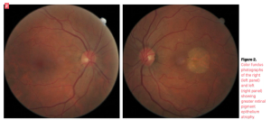 Central serous retinopathy is not a benign disease
