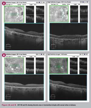 Masquerading maculopathy: The importance of correct diagnosis