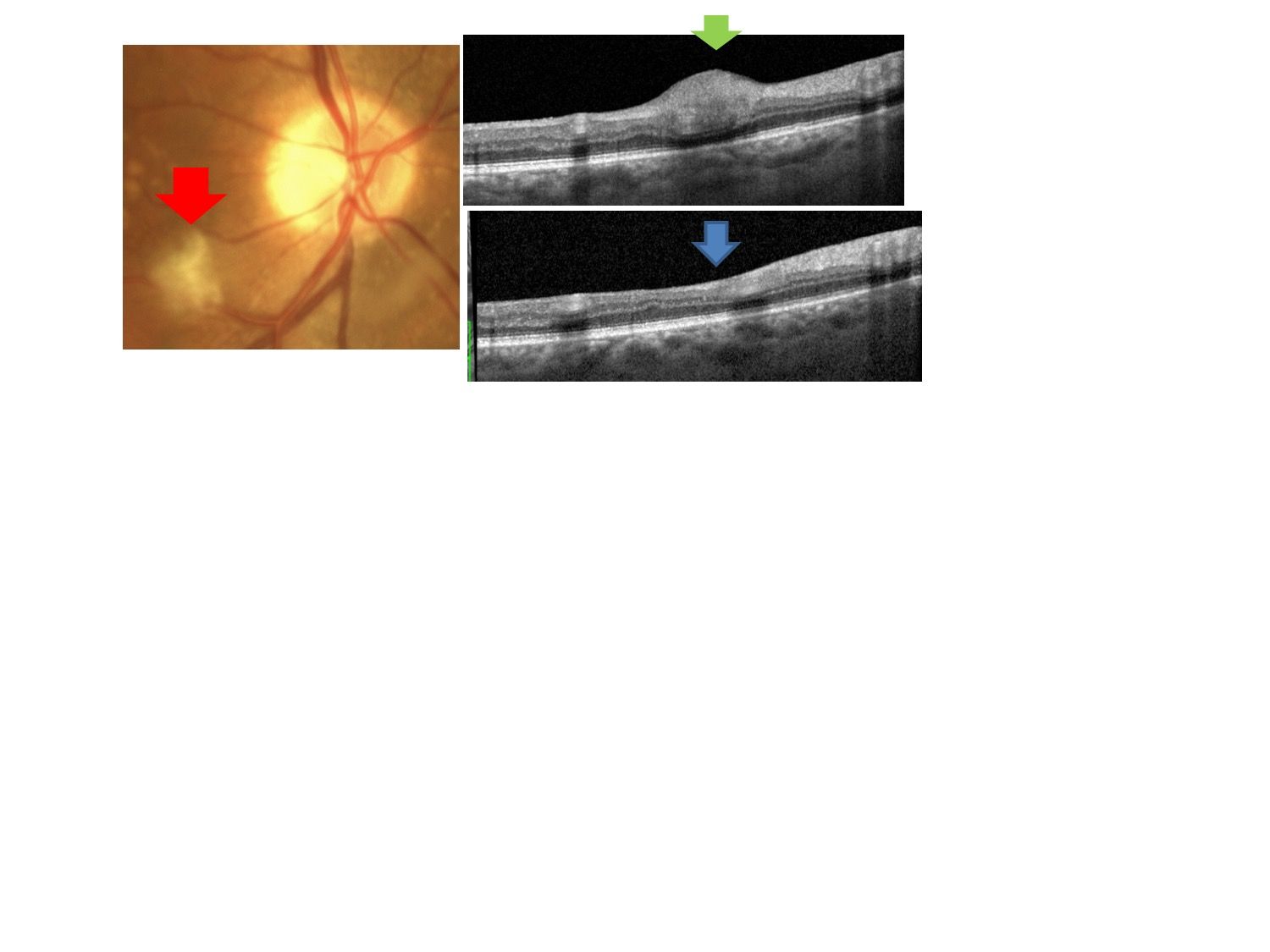 What Causes Vision Loss In Diabetic Patients Optometry Times