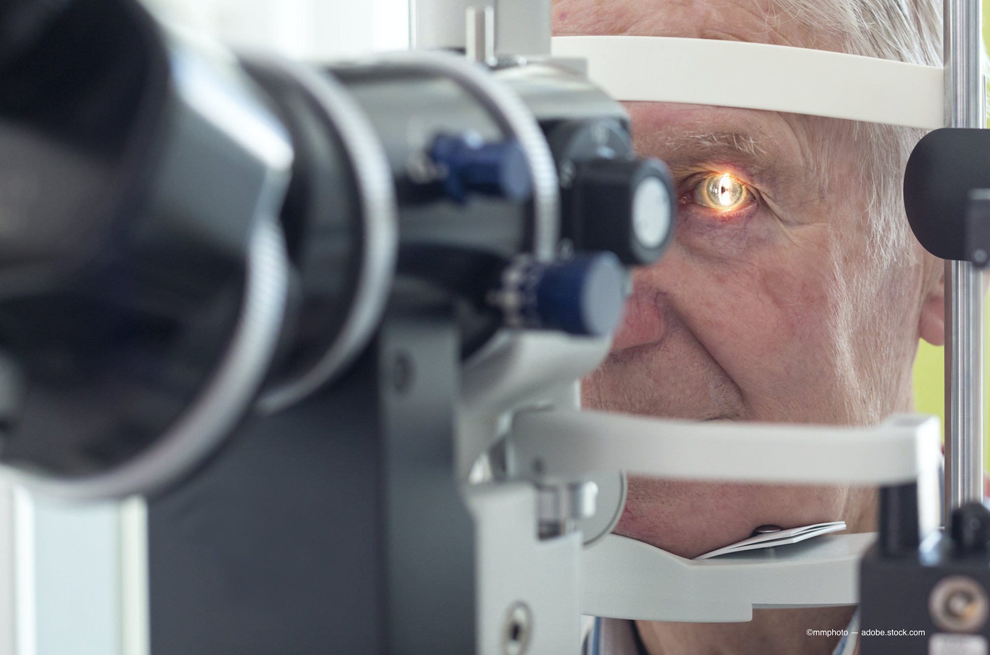 6 steps to prepare former LASIK patients for cataract