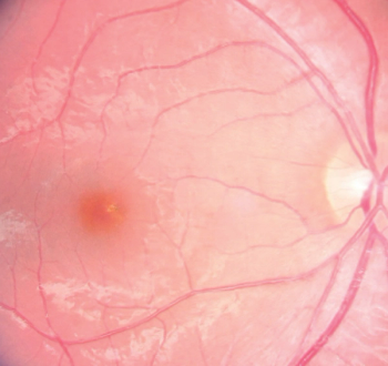 Careful evaluation of ophthalmic diagnostics in retinal cases