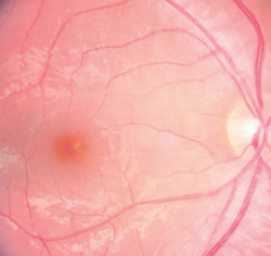 Careful evaluation of ophthalmic diagnostics in retinal cases
