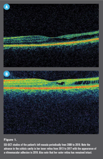 Scan of patient's left macula