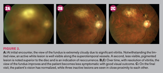 cloudy fundus apparent in retina scan