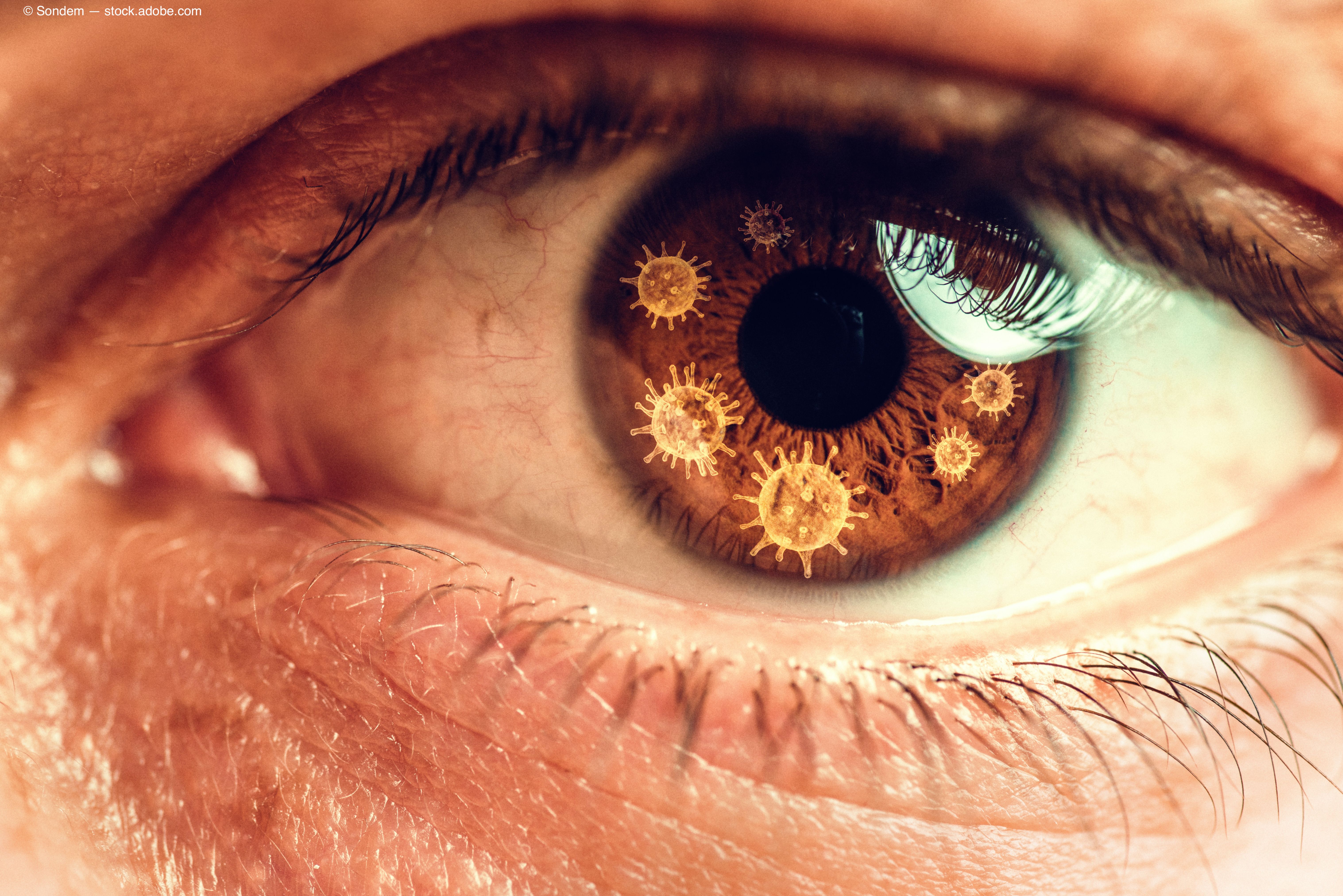 Contact lens regimen crucial in removing coronavirus traces