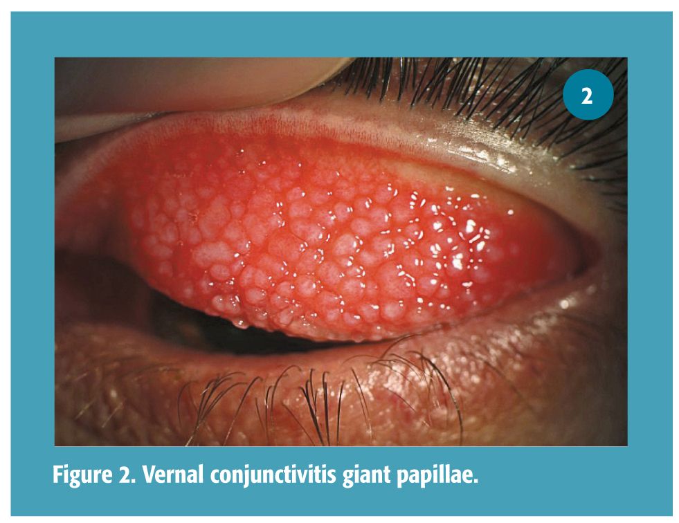 giant papillary conjunctivitis treatment