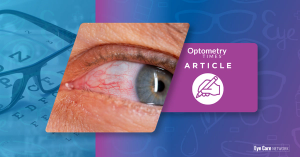 Closeup of eye with keratitis Image credit: AdobeStock/wifesun