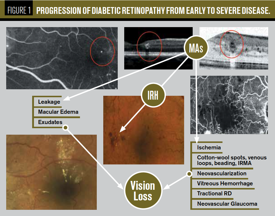Case report Don’t be misled by diabetic retinopathy Optometry Times