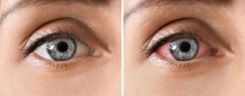 Closeup of healthy eye and uveitic eye Image credit: AdobeStock/Pixel-Shot