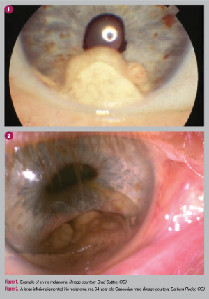iris melanoma