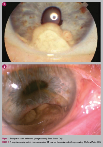 iris melanoma