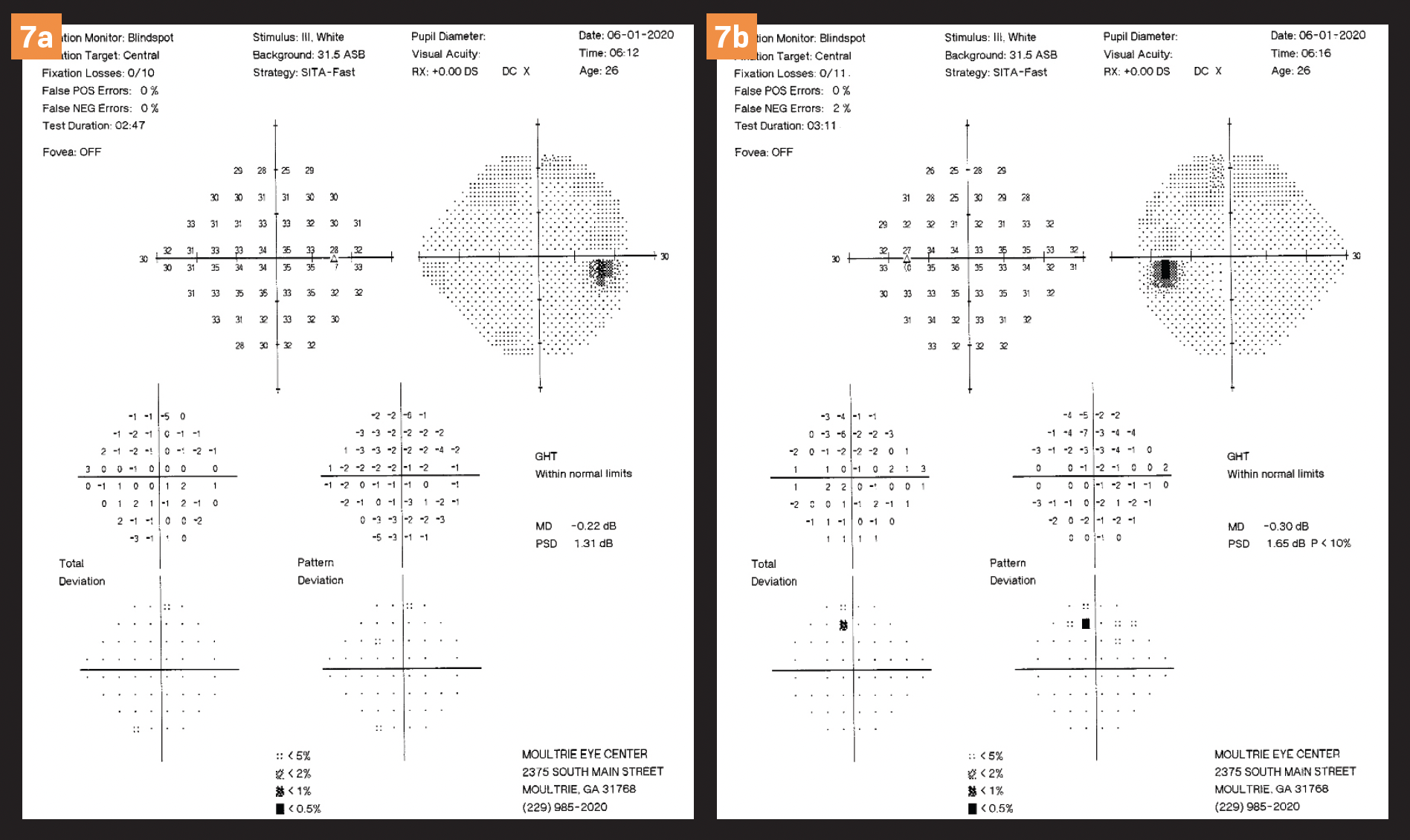 Figure 7 a/b. Normal visual field OU. (All images courtesy of Barbara Fluder, OD)