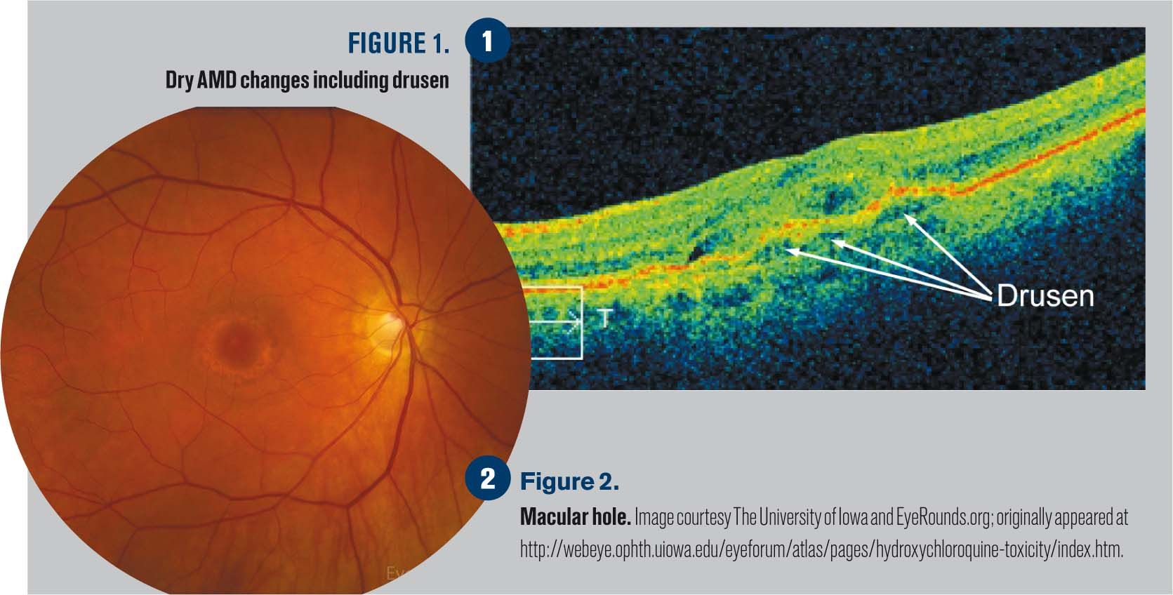 Identifying common macular conditions with OCT