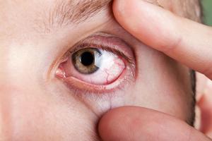 Closeup of irritated eye Image credit: AdobeStock/ia_64