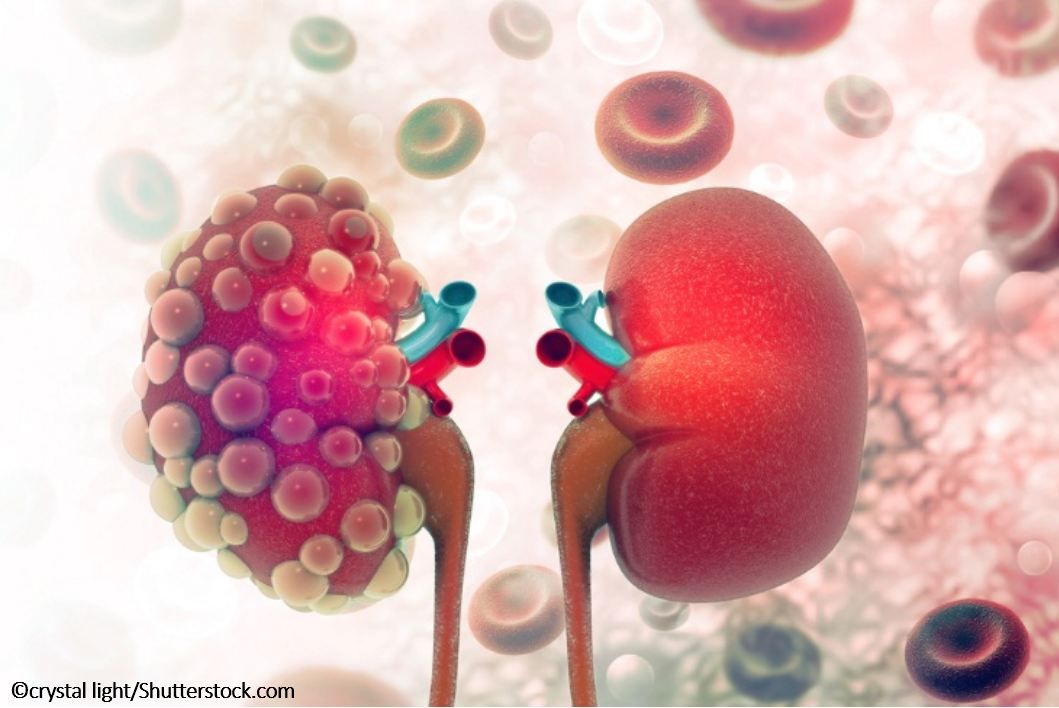 Polycystic Kidney Disease, Polycystic Kidney Disease treatment, ADPKD, CKD